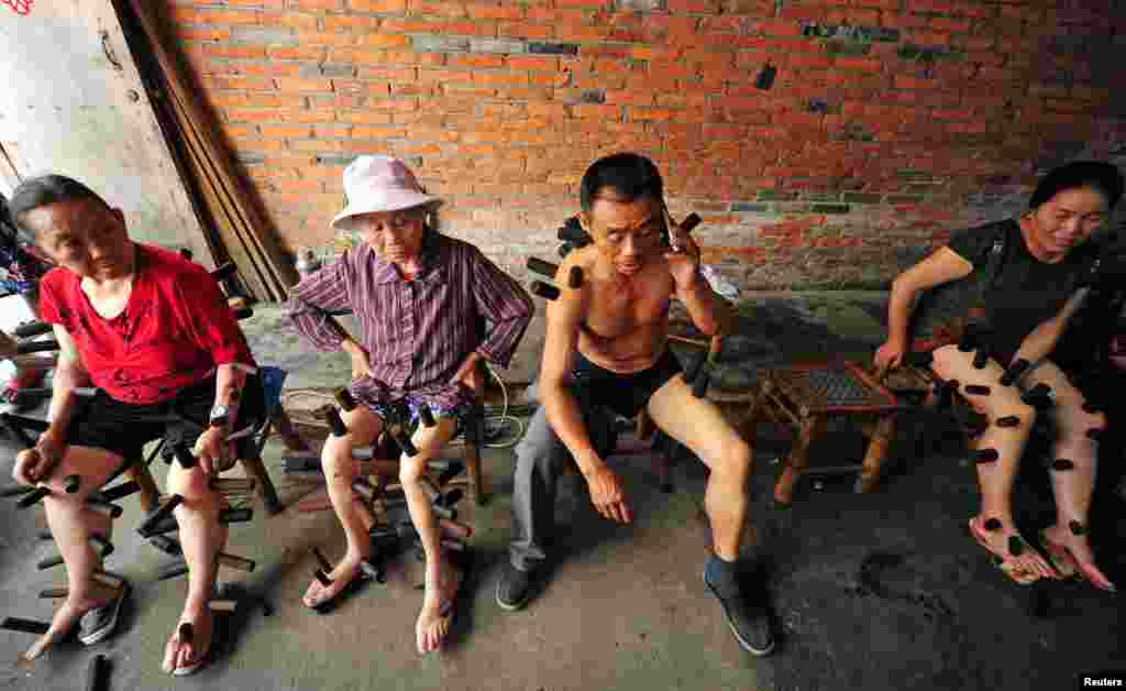 Warga setempat menjalani terapi bekam tradisional di sebuah klinik di Pujiang, Chengdu, China.
