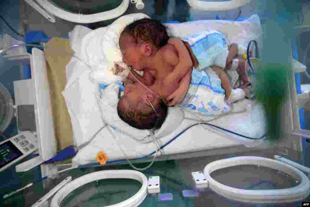 Newborn conjoined twins lie in an incubator at the child intensive care unit of al-Sabeen hospital in Yemen's capital Sanaa. The boys, born in war-ravaged Yemen, are in critical condition and in need of treatment abroad, according to the hospital.