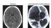 Hydrocephalus, or water on the brain, affects 100,000 children every year in Africa alone. (Credit: Schiff)